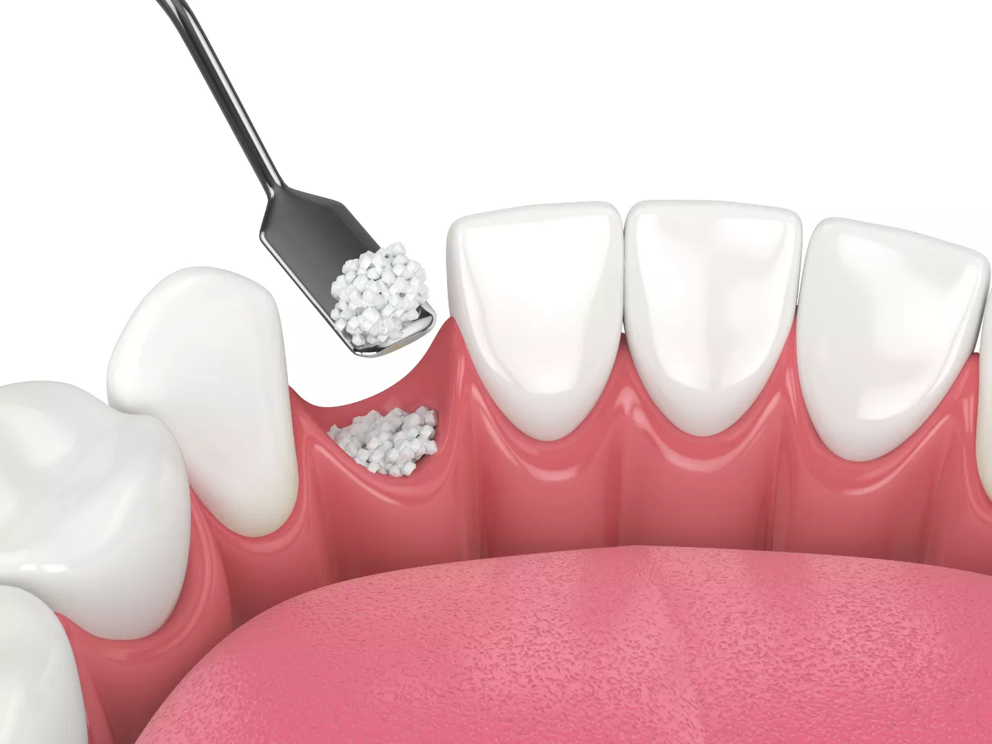 Illustration of bone grafting techniques.