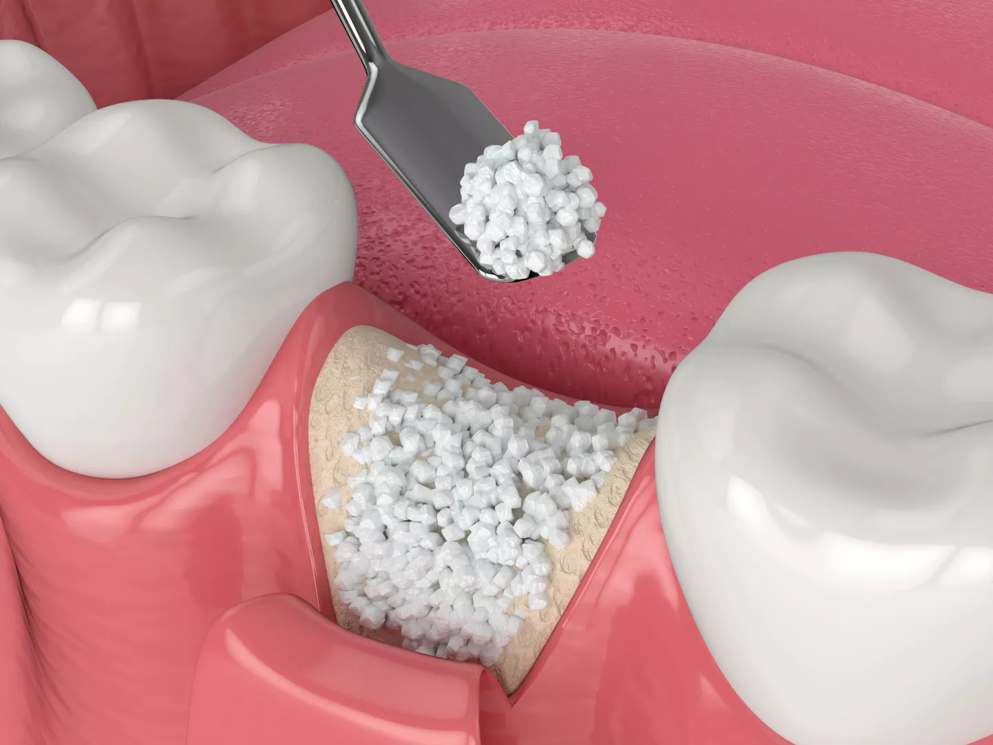 Illustration of bone grafting techniques.