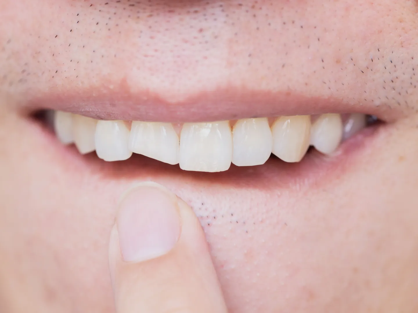 Man pointing at his chipped tooth.