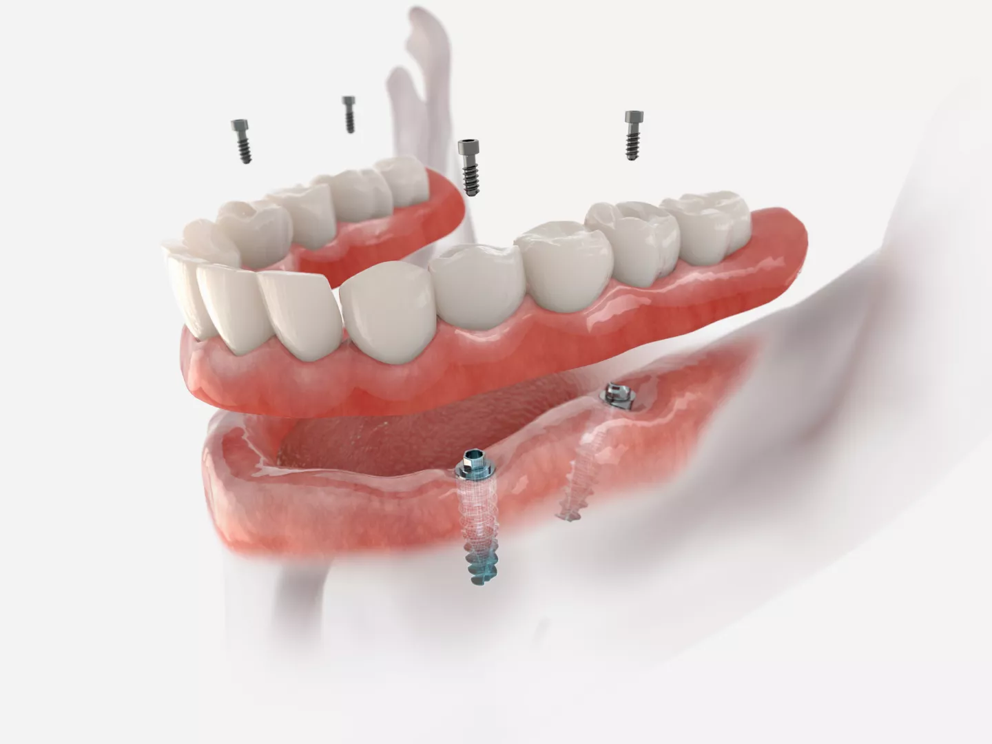 Illustration of a full mouth implant exposing layers and screws.