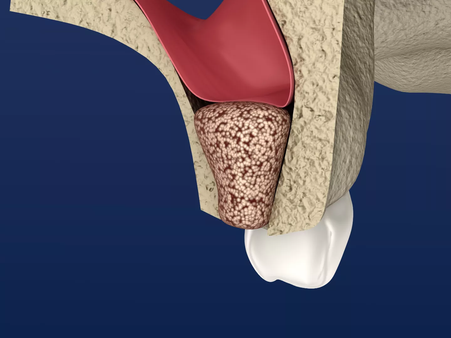 Illustration of a completed sinus lift.