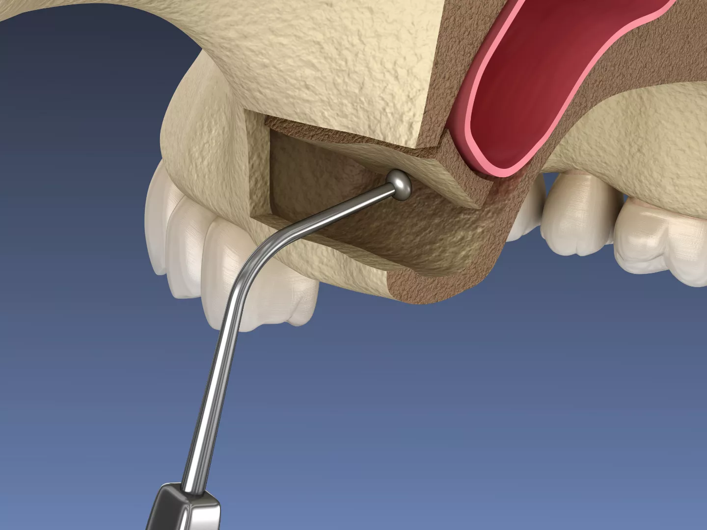 Illustration of a sinus lift procedure.