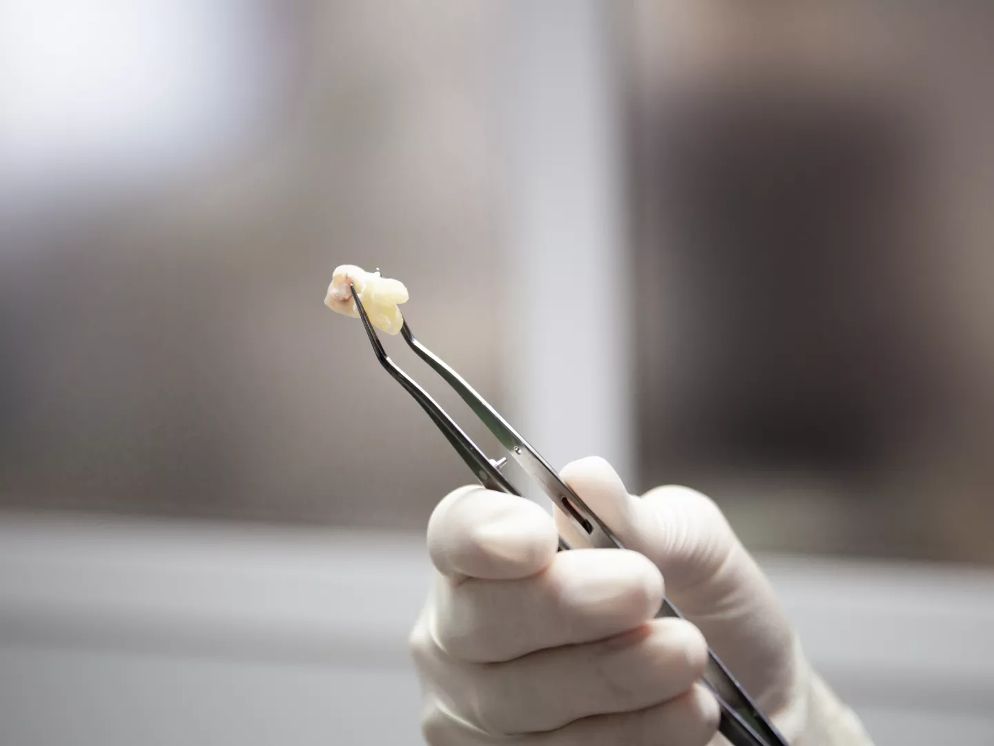 An image of a gloved hand holding an extracted tooth with medical instruments.