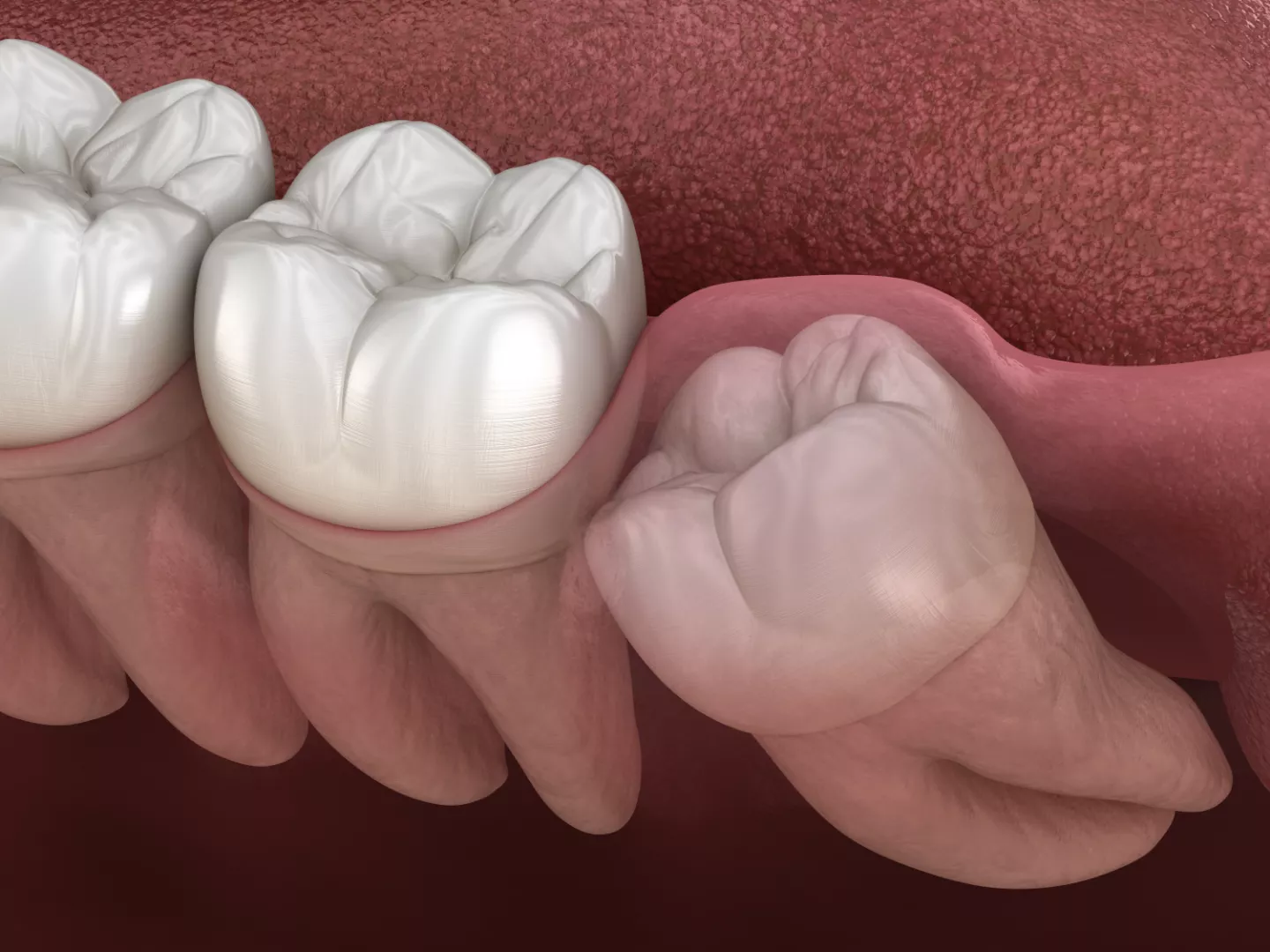 Illustration of crowding in the rear of the mouth.