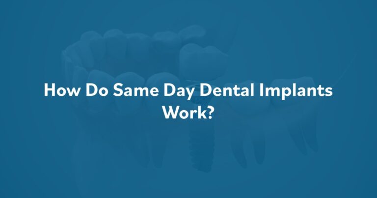 How Do Same Day Dental Implants Work? at Southern Oral & Facial Surgery