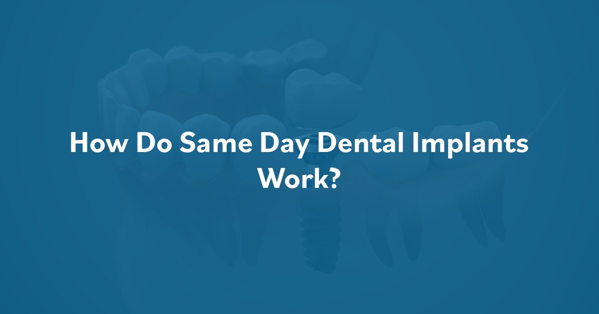 How Do Same Day Dental Implants Work? at Southern Oral & Facial Surgery